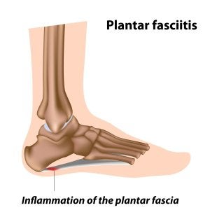 Plantar fasciitis sales spur on heel